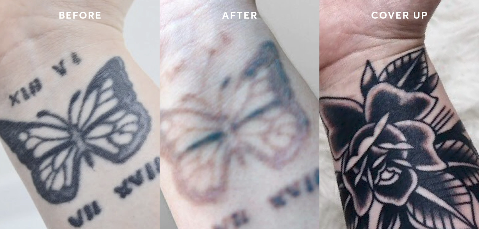 Can You Tattoo Over a Removed Tattoo? - TattooProfy
