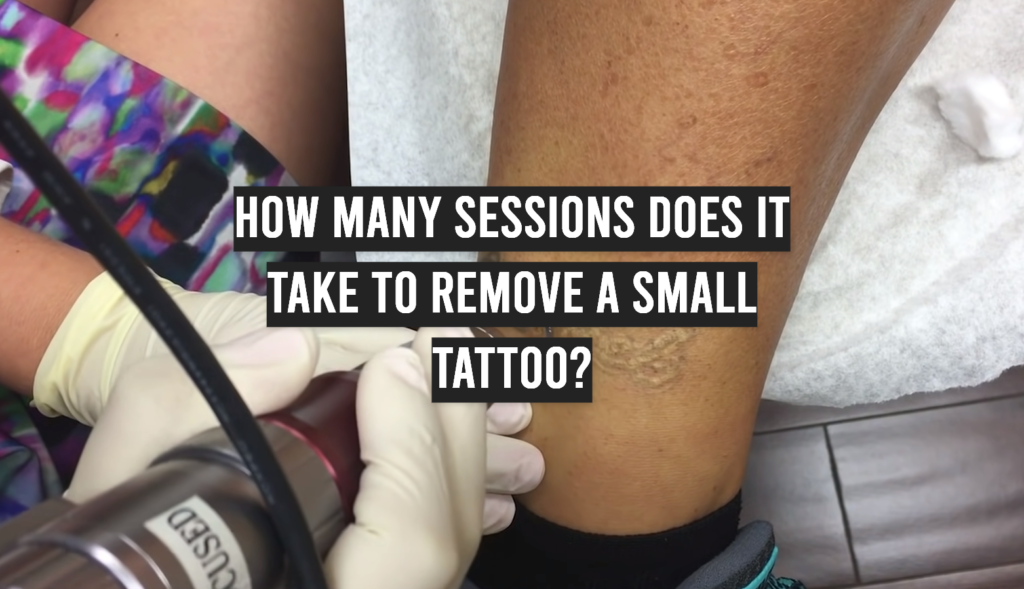 How Many Sessions Does It Take To Remove a Small Tattoo? - TattooProfy